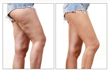 Laser Lipo before and after effects