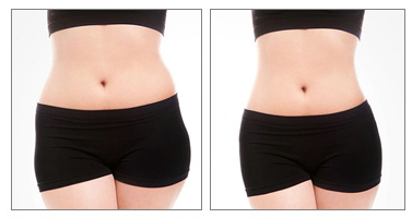 Laser Lipo before and after reviews