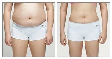 Laser Lipo before and after obvious comparison