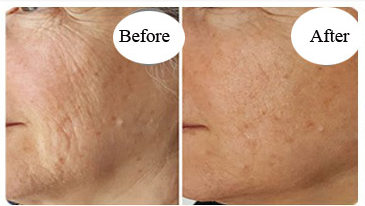 Fraxel Laser Before And After comparison