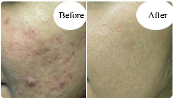 Fraxel Laser Before And After images