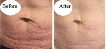 Fraxel Laser Before And After results