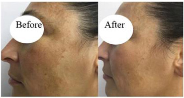 Fraxel Laser Before And After reviews