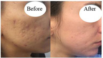 Fraxel Laser Before And After pictures