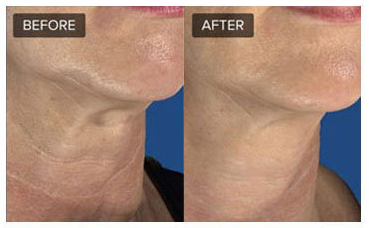 Microneedling before and after images