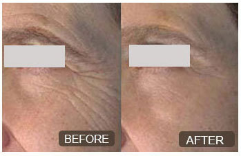 Microneedling before and after pictures