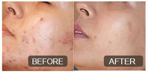 Microneedling before and after effects