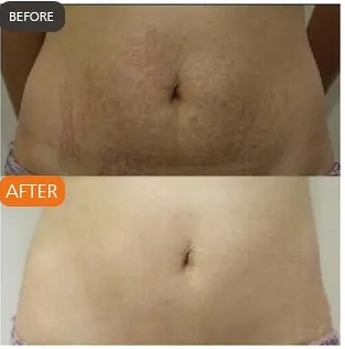 Microneedling before and after reviews