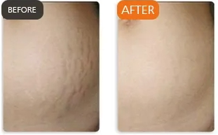 Microneedling before and after comparison