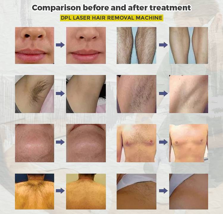 Ipl Laser Hair Removal Machine Before And After