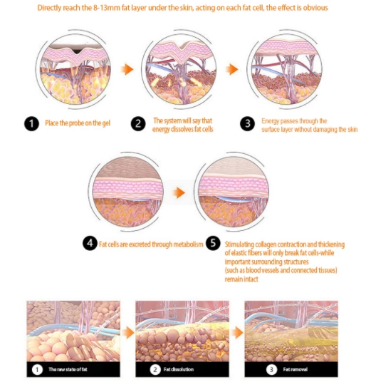 How does Liposonic Hifu Machine work