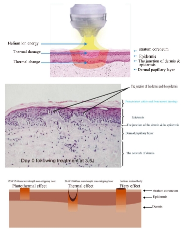 Working principle of Plasma Skin Tightening Treatment