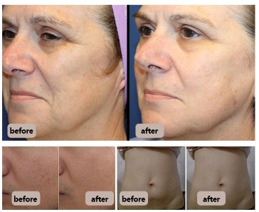 Plasma Skin Tightening Treatment Before And After