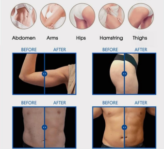 Ems Sculpt Machine Before and After