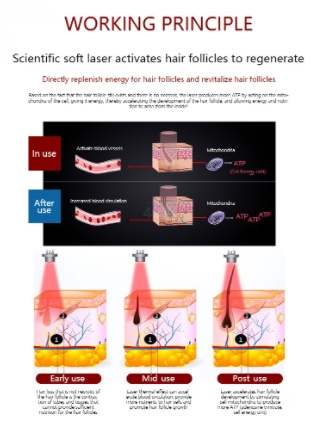 working theory of Laser Hair Regrowth Treatment