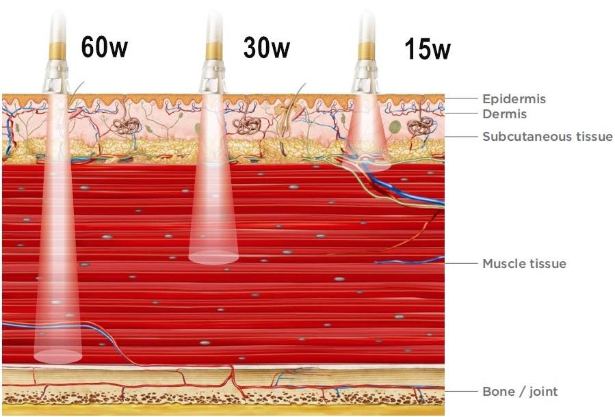 How does Diode Laser Therapy Device work