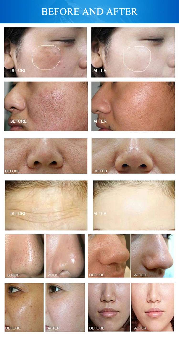 Hydrodermabrasion Before And After