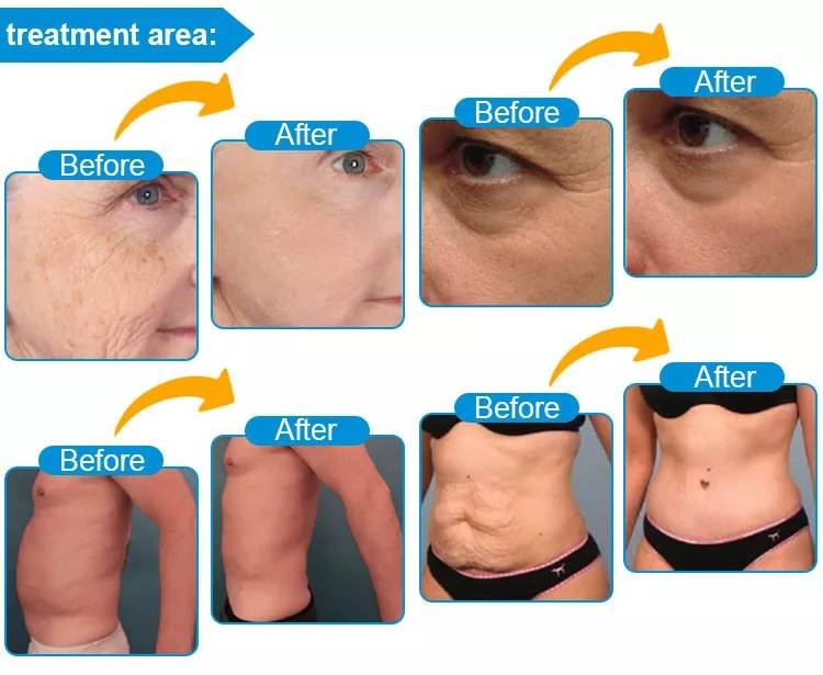 Hifu Before And After Hifu Facial Machine