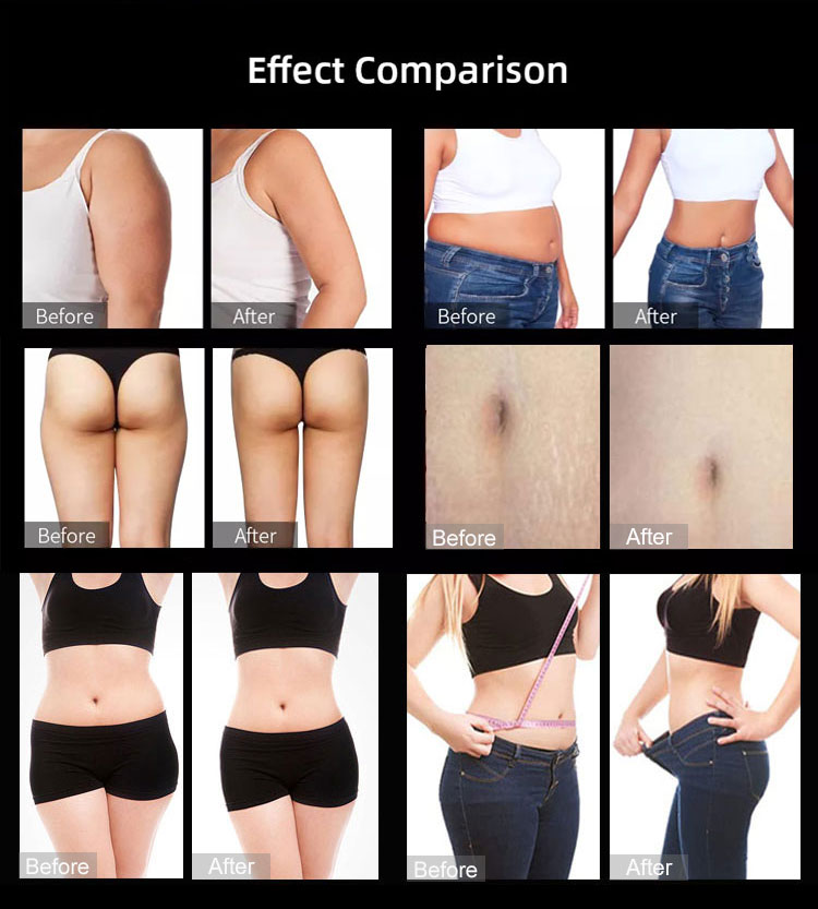 The effects of Ultrasound Fat Cavitation Machine